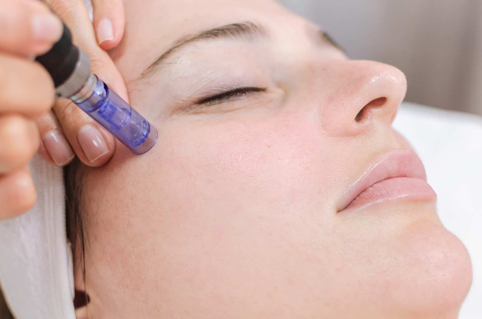 nano-needling